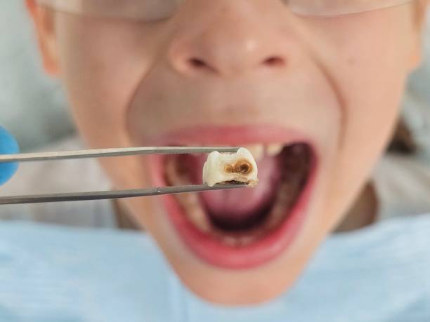 Best Emergency Tooth Extraction in Yakima, WA